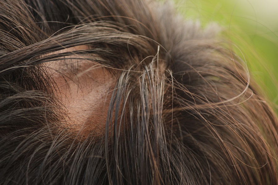 درمان ریزش موی سکه ای