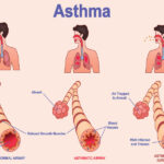 Asthma guide