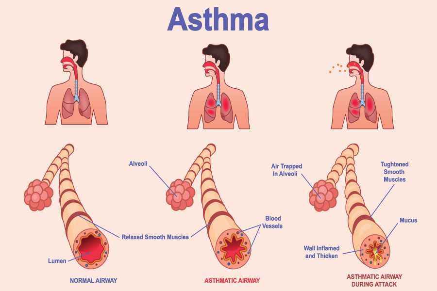 Asthma guide