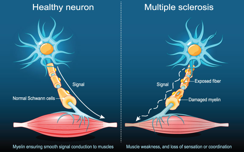 بیماری ام اس