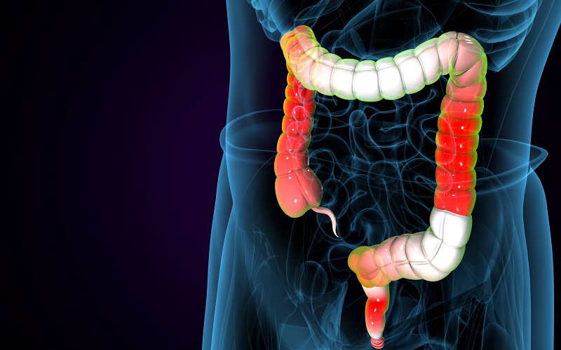  کولیت اولسراتیو