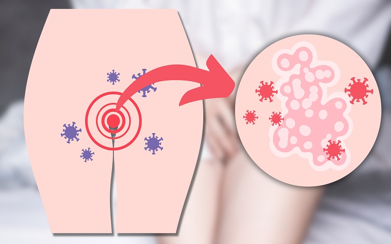 درمان زگیل تناسلی