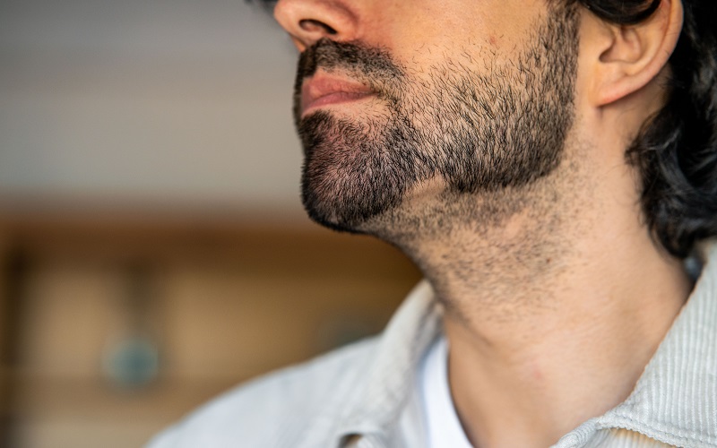 تغییرات ظاهری در ریزش سکه ای ریش