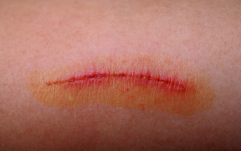 نشانه‌های خطر در فرآیند بهبود زخم