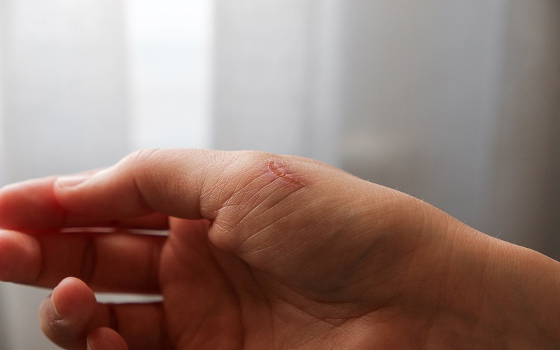 چقدر طول می‌کشد تا زخم‌ها بهبود یابند؟