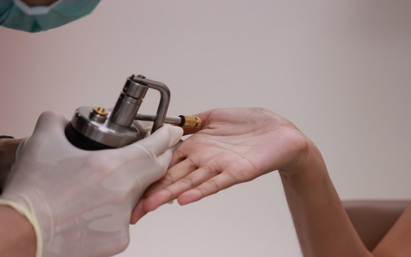 کرایوتراپی