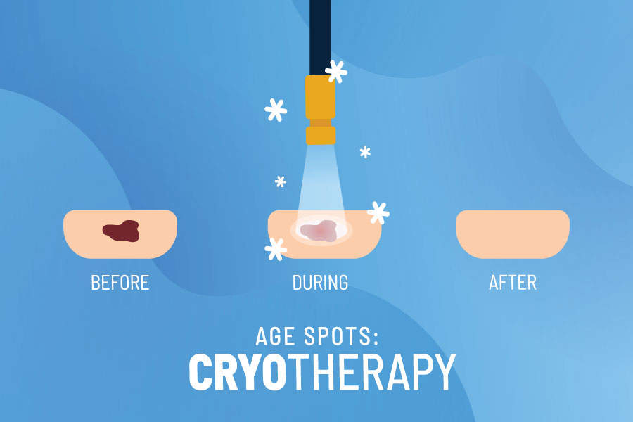 Cryotherapy