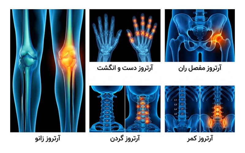 انواع آرتروز