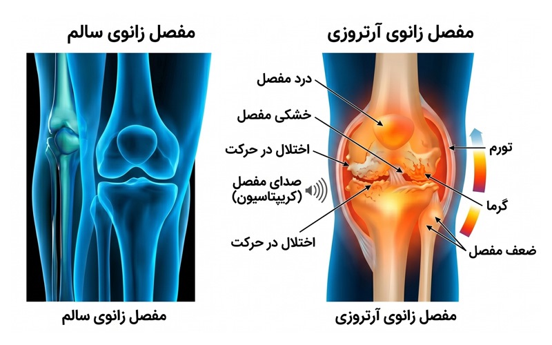 مقایسه مفصل سالم و ناسالم