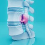 تاثیر کاهش وزن بر دیسک کمر