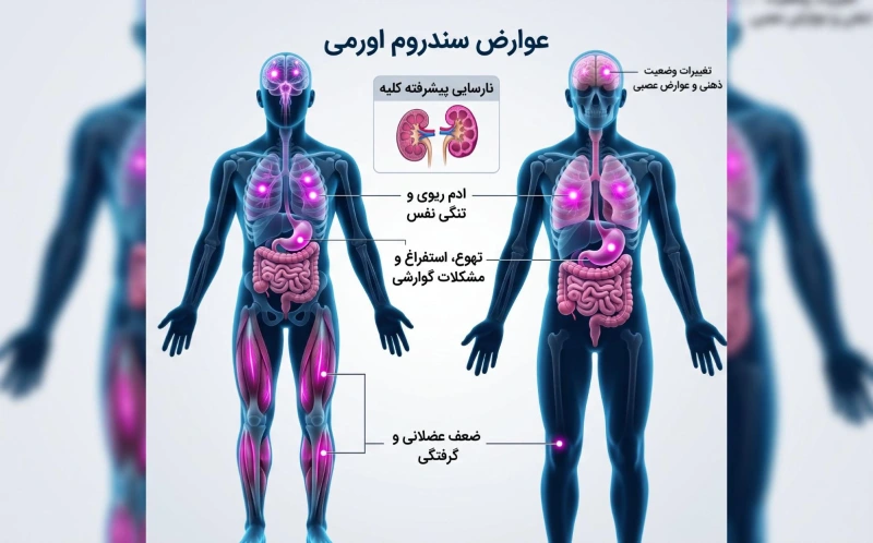 نمودار بالینی عوارض پیشرفته نارسایی کلیه و اثرات سندروم اورمی بر ریه، مغز و عضلات