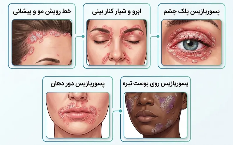 عکس پسوریازیس صورت در خط رویش مو، ابرو، پلک، دور دهان و روی پوست تیره
