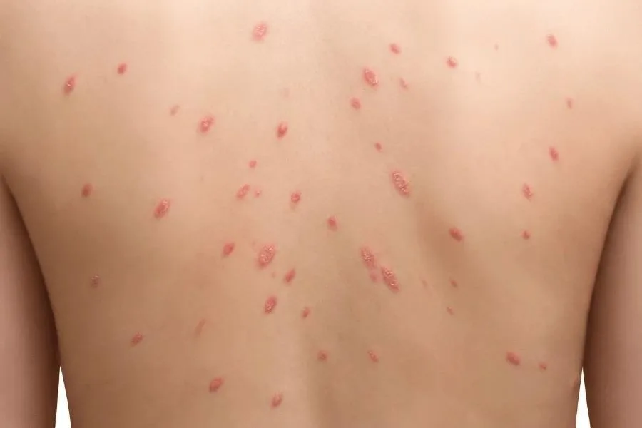 پسوریازیس قطره‌ای روی پوست پشت با ضایعات قطره‌ای کوچک و قرمز
