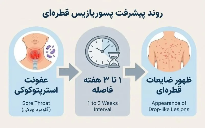 روند پیشرفت پسوریازیس قطره‌ای؛ عفونت استرپتوکوکی گلو، فاصله ۱ تا ۳ هفته و ظهور ضایعات