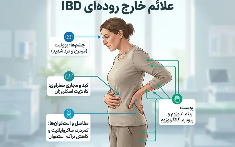 علائم خارج رودهای IBD در چشم، کبد، پوست و مفاصل