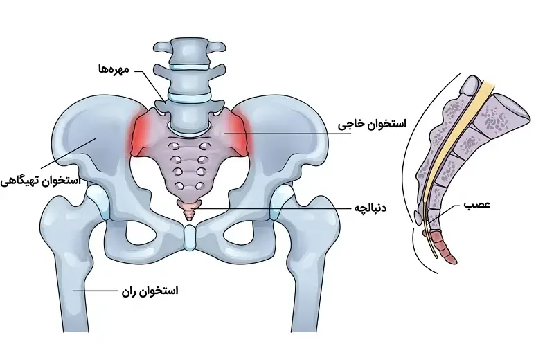 التهاب مفصل ساکروایلیاک در اسپوندیلوآرتریت انتروپاتیک