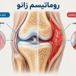 روماتیسم زانو