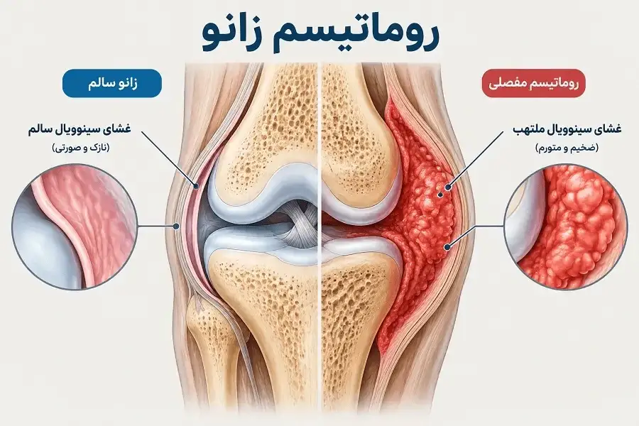 روماتیسم زانو